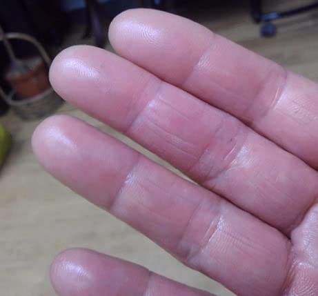 ボロボロだった指に効いたのは塩と水とオイル ― 手荒れに悩む美容師さん、すべての人へ ―